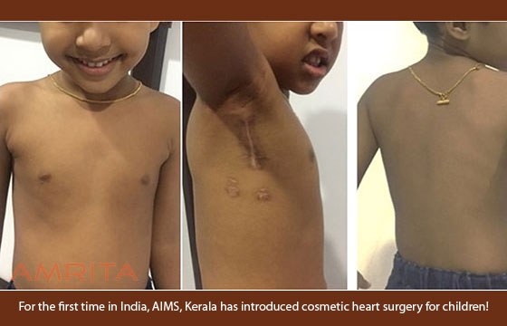 AIMS introduces cosmetic cardiac surgery for children