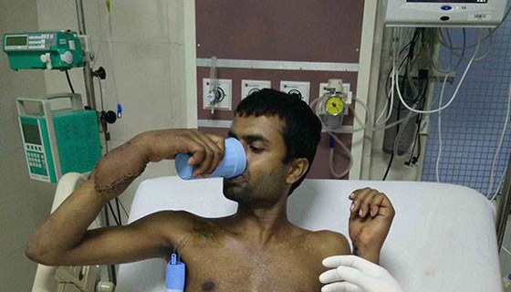 Hand Transplant in AIMS